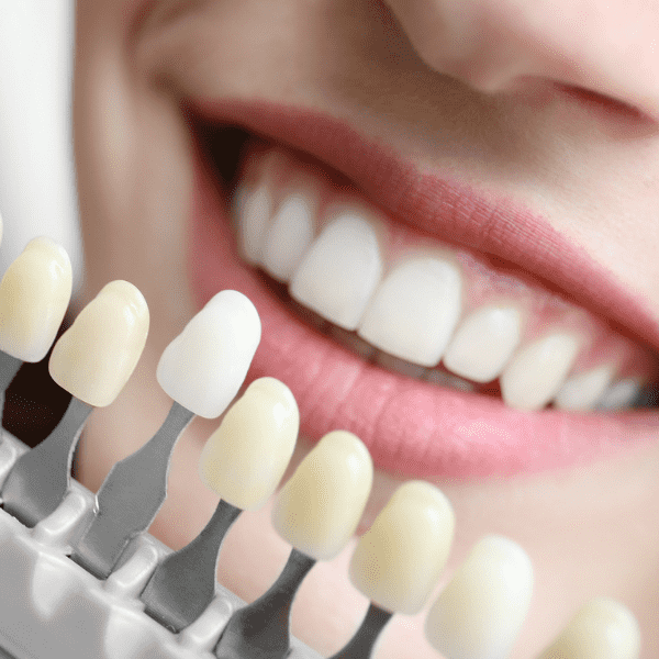 Teeth Whitening Taupo