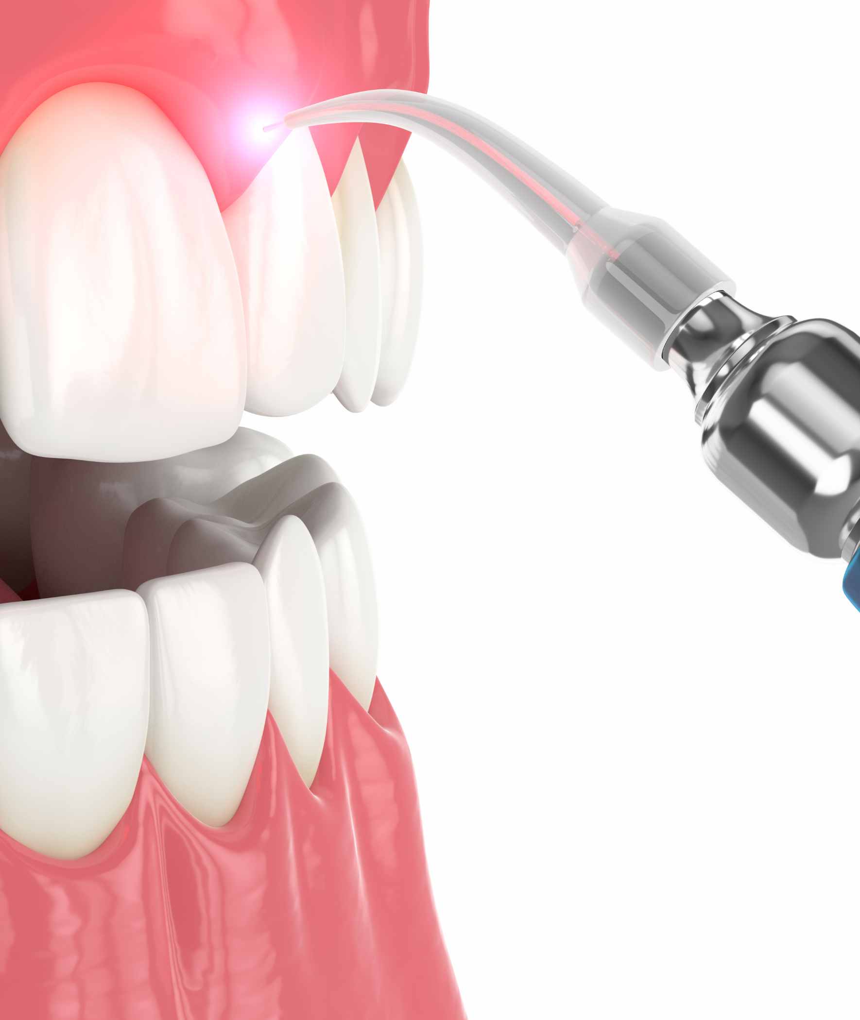 Taupo laser therapy dental